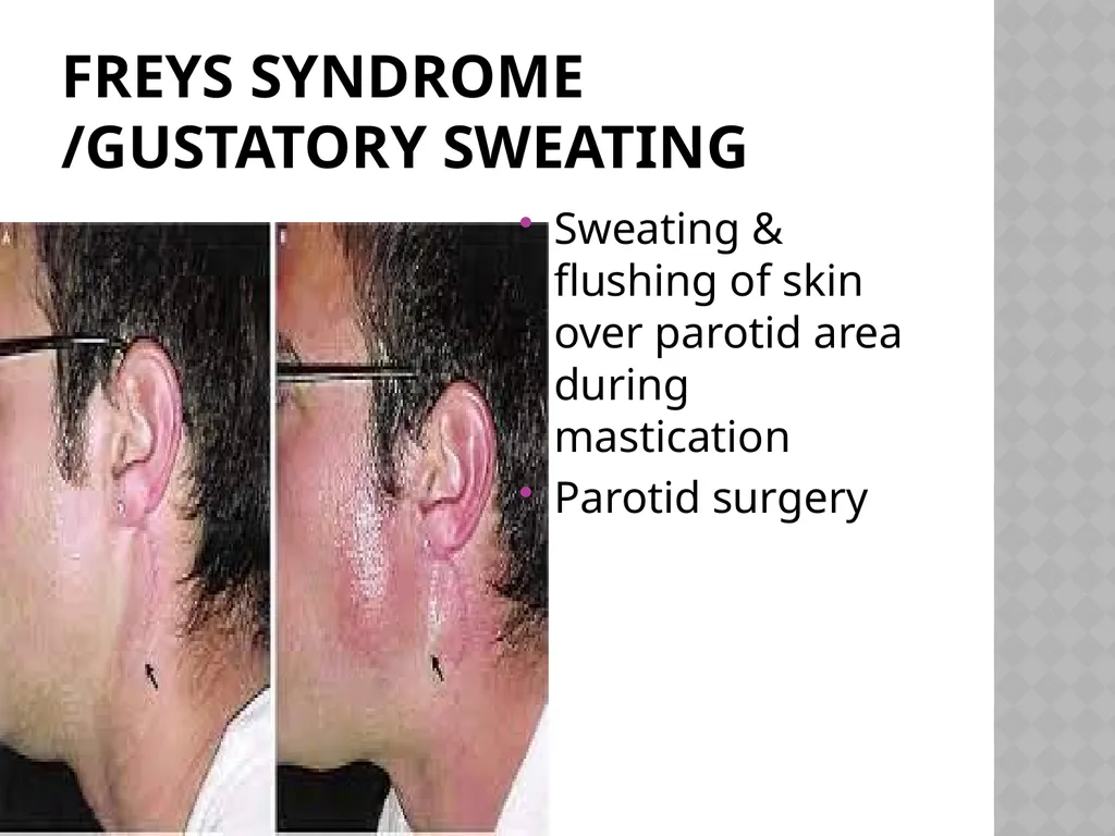 FACIAL NERVE PLASY Dr.Satguru Saran Singh - slide 52 of 53