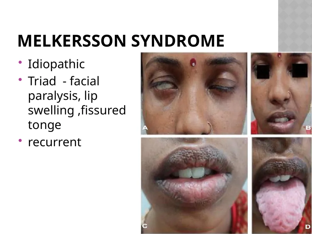 FACIAL NERVE PLASY Dr.Satguru Saran Singh - slide 40 of 53