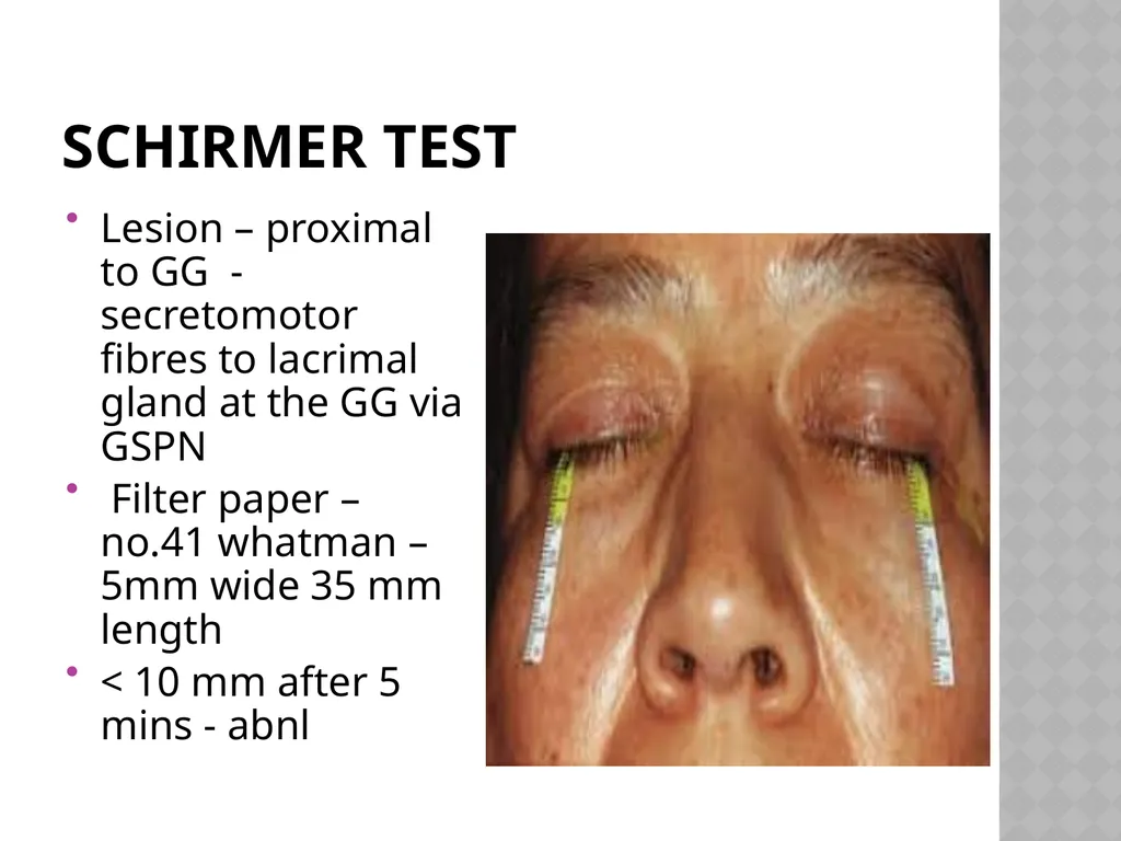 FACIAL NERVE PLASY Dr.Satguru Saran Singh - slide 46 of 53
