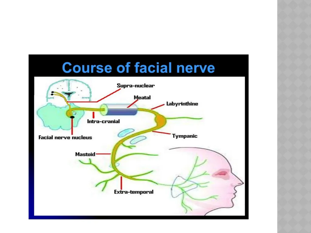 FACIAL NERVE PLASY Dr.Satguru Saran Singh - slide 14 of 53