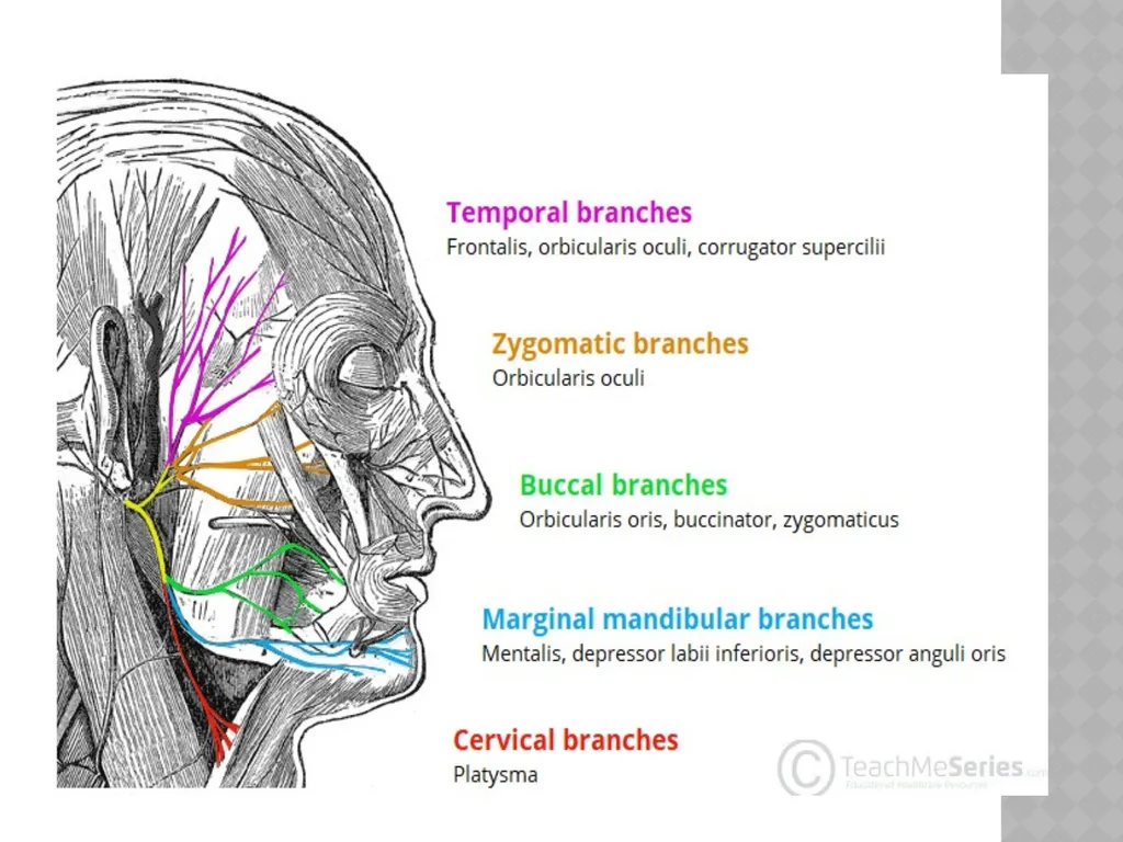 FACIAL NERVE PLASY Dr.Satguru Saran Singh - slide 17 of 53