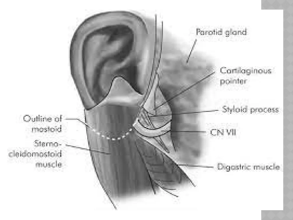 FACIAL NERVE PLASY Dr.Satguru Saran Singh - slide 23 of 53