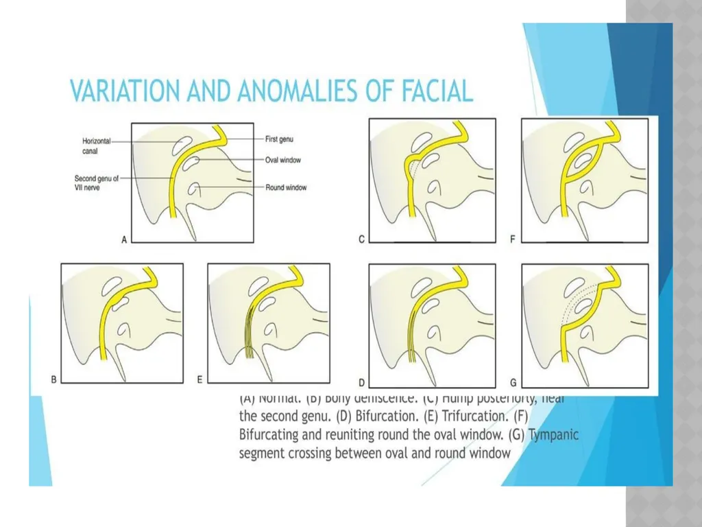 FACIAL NERVE PLASY Dr.Satguru Saran Singh - slide 25 of 53