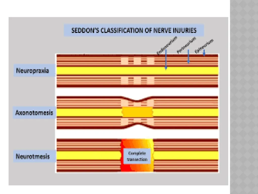 FACIAL NERVE PLASY Dr.Satguru Saran Singh - slide 27 of 53