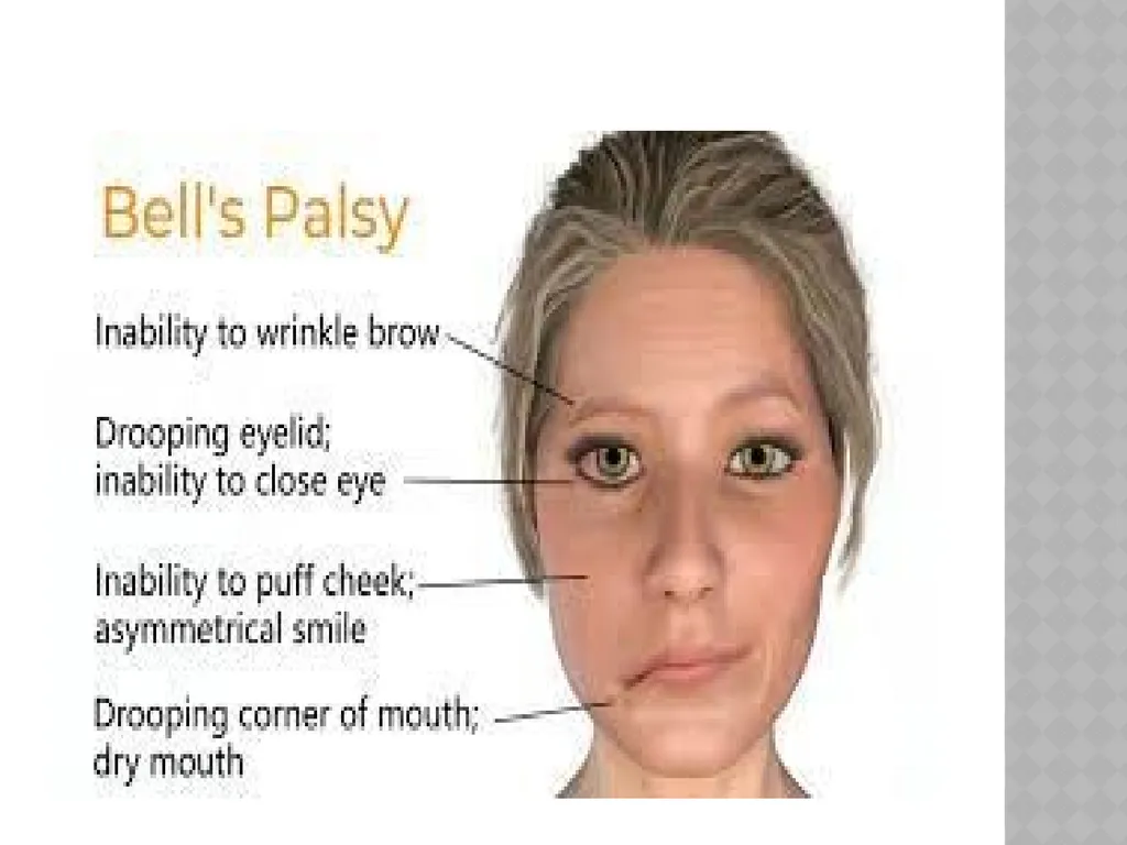 FACIAL NERVE PLASY Dr.Satguru Saran Singh - slide 36 of 53