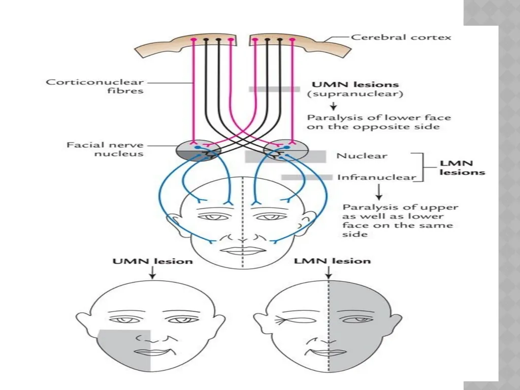 FACIAL NERVE PLASY Dr.Satguru Saran Singh - slide 5 of 53