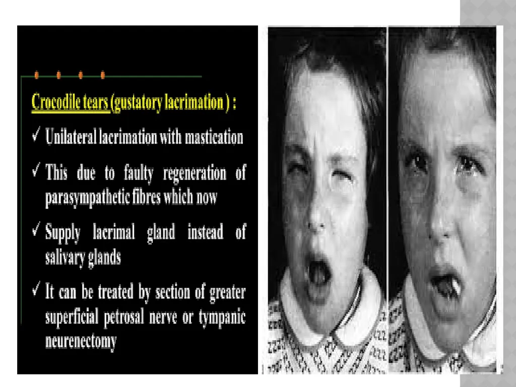 FACIAL NERVE PLASY Dr.Satguru Saran Singh - slide 51 of 53