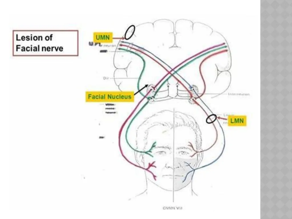 FACIAL NERVE PLASY Dr.Satguru Saran Singh - slide 6 of 53