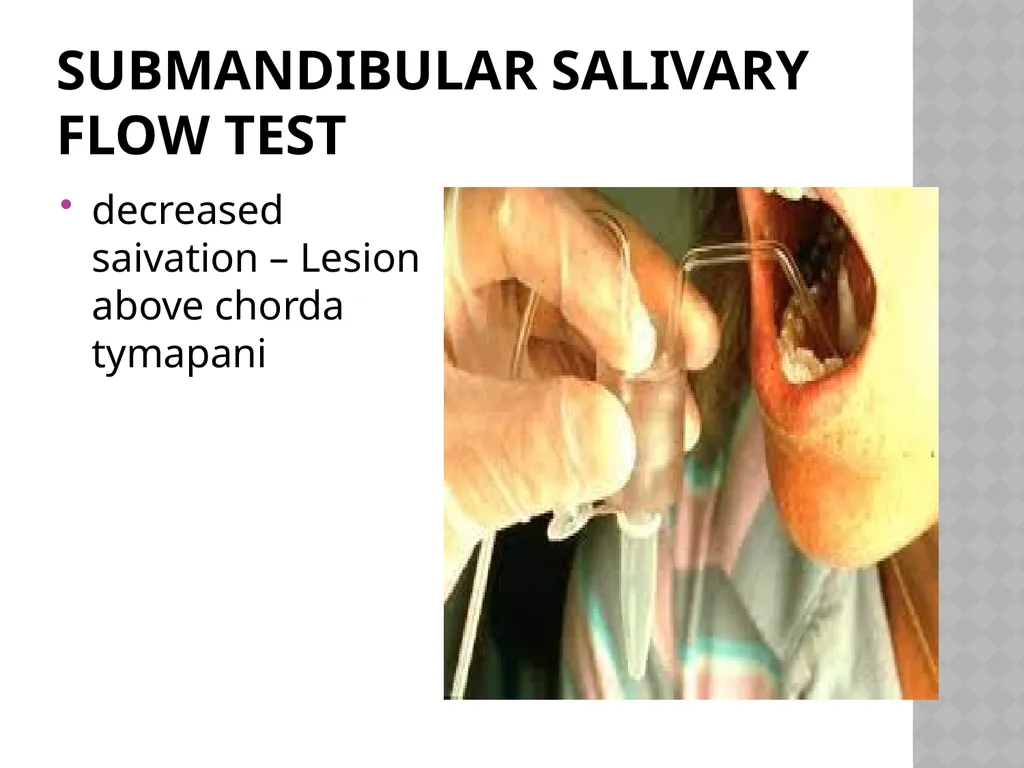 FACIAL NERVE PLASY Dr.Satguru Saran Singh - slide 49 of 53
