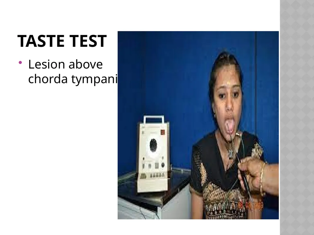 FACIAL NERVE PLASY Dr.Satguru Saran Singh - slide 48 of 53