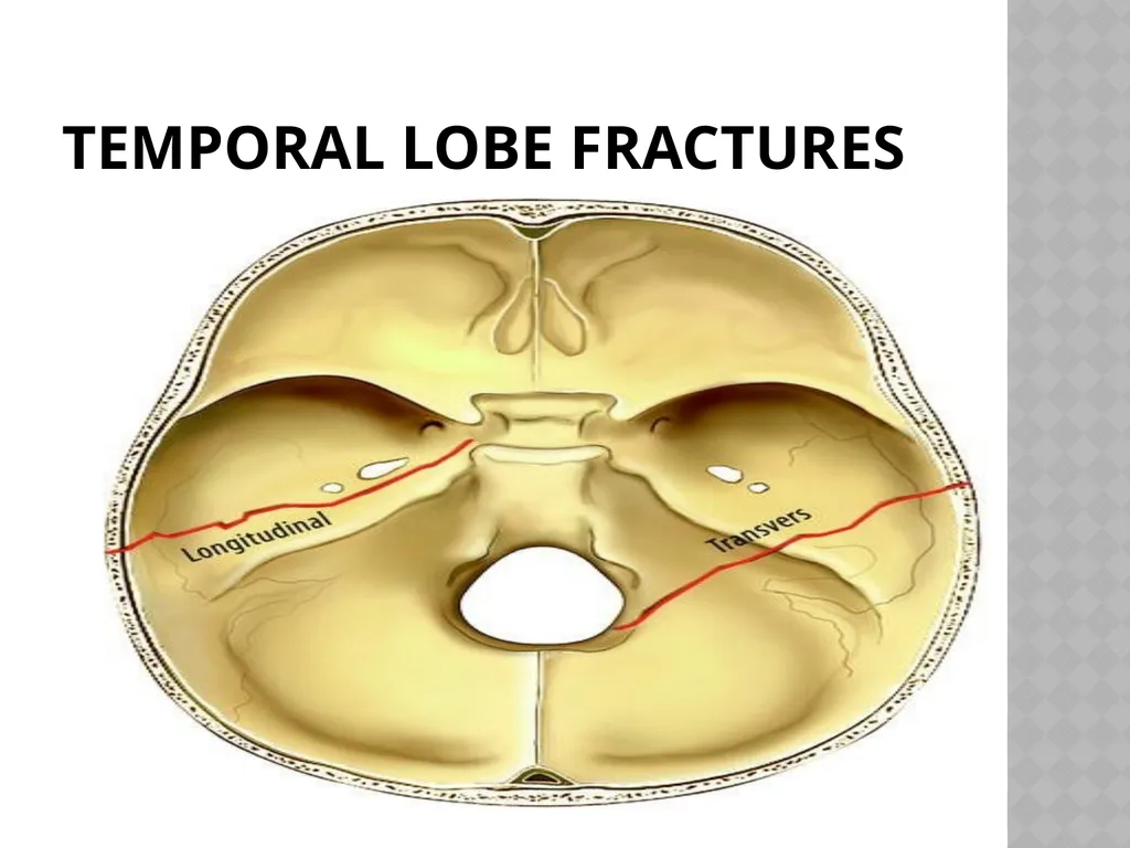 FACIAL NERVE PLASY Dr.Satguru Saran Singh - slide 43 of 53