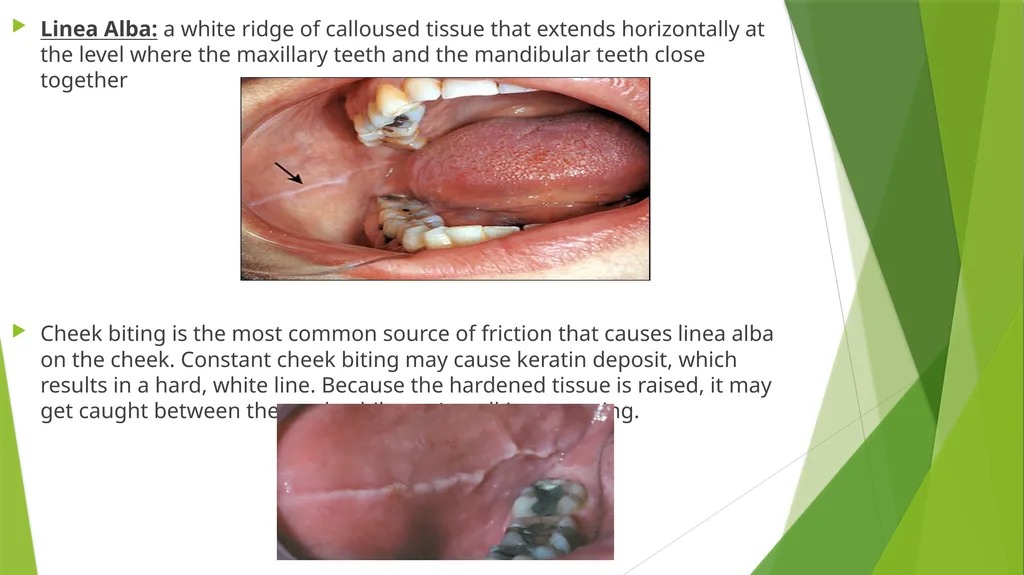Fordyce Granules (Spots) & Linea Alba Denise - slide 4 of 6