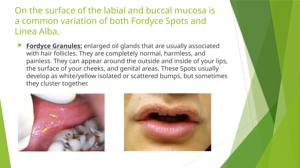 Fordyce Granules (Spots) & Linea Alba Denise - slide 2 of 6