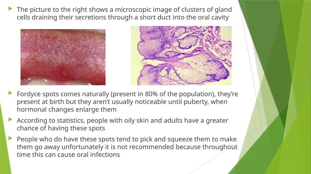 Fordyce Granules (Spots) & Linea Alba Denise - slide 3 of 6