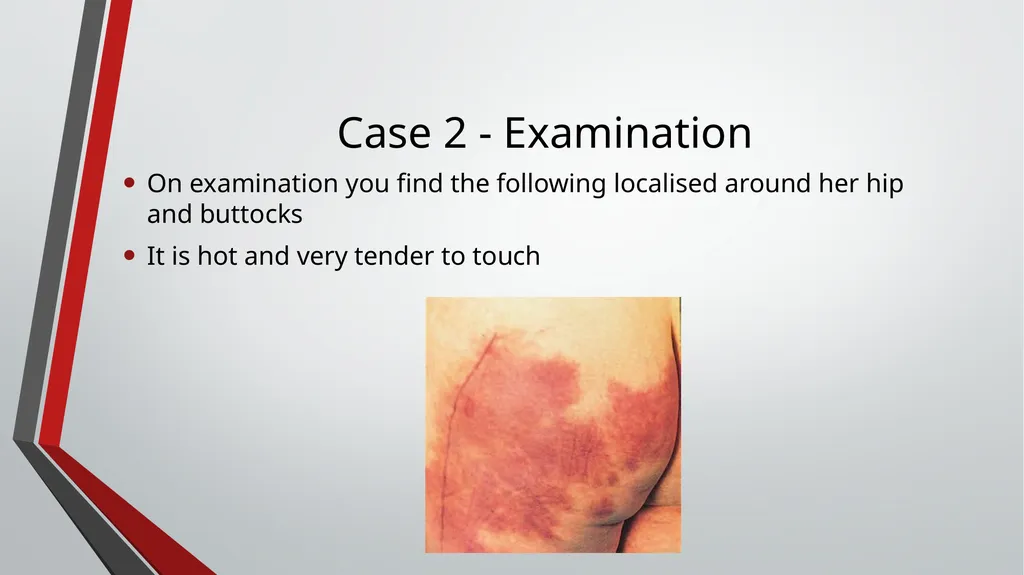 Bursitis and Septic Arthritis Thomas Diffley This - slide 31 of 43