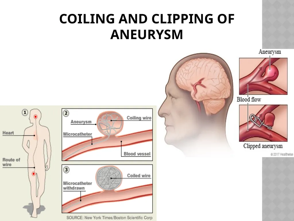 Cerebro VASCULAR ACCIDENT(CVA) / STROKE - slide 17 of 19