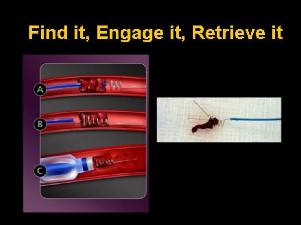 Cerebro VASCULAR ACCIDENT(CVA) / STROKE - slide 16 of 19