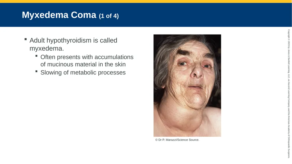 Endocrine Emergencies CHAPTER 24 Introduction - slide 92 of 102