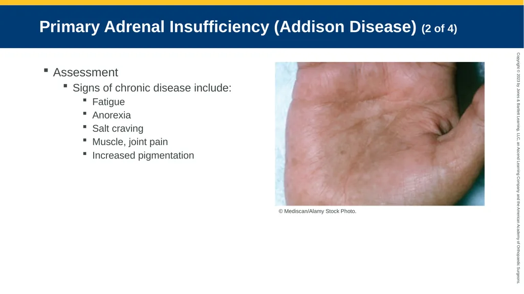 Endocrine Emergencies CHAPTER 24 Introduction - slide 78 of 102