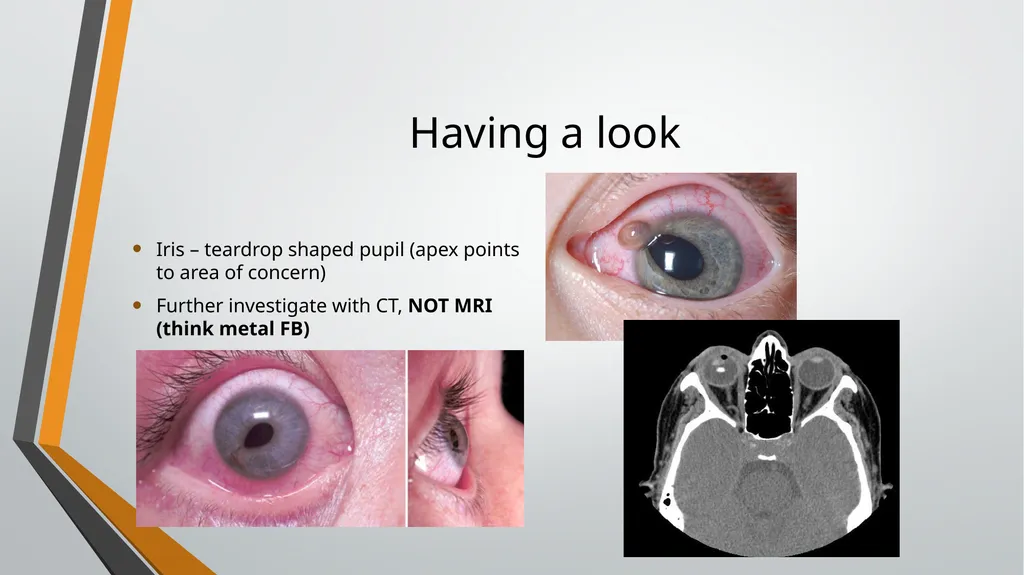 I think I have got something in my eye Foreign - slide 7 of 19