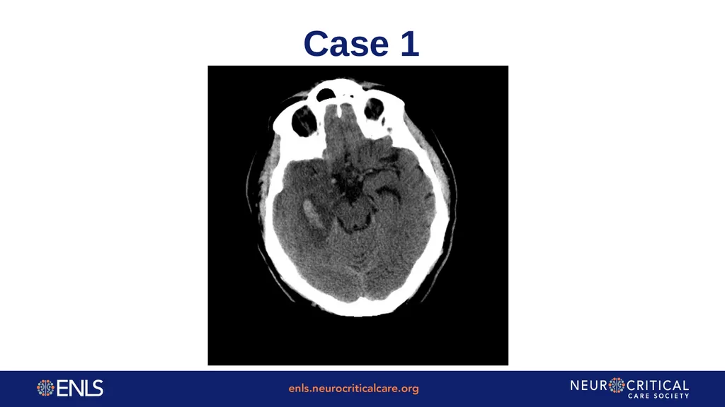 ENLS Version 5.0 Meningitis And Encephalitis - slide 14 of 39