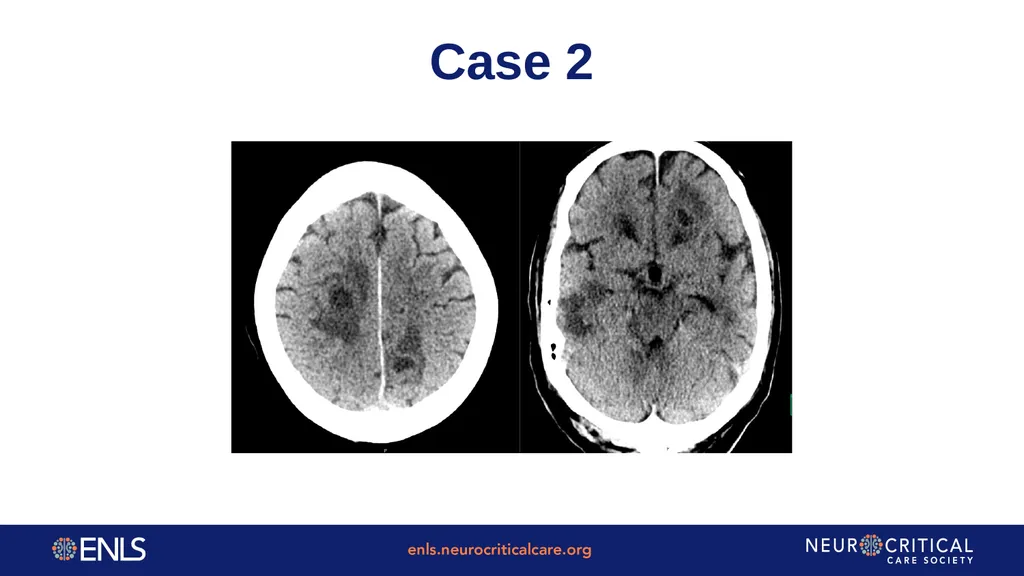 ENLS Version 5.0 Meningitis And Encephalitis - slide 26 of 39