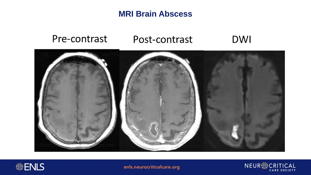 ENLS Version 5.0 Meningitis And Encephalitis - slide 28 of 39