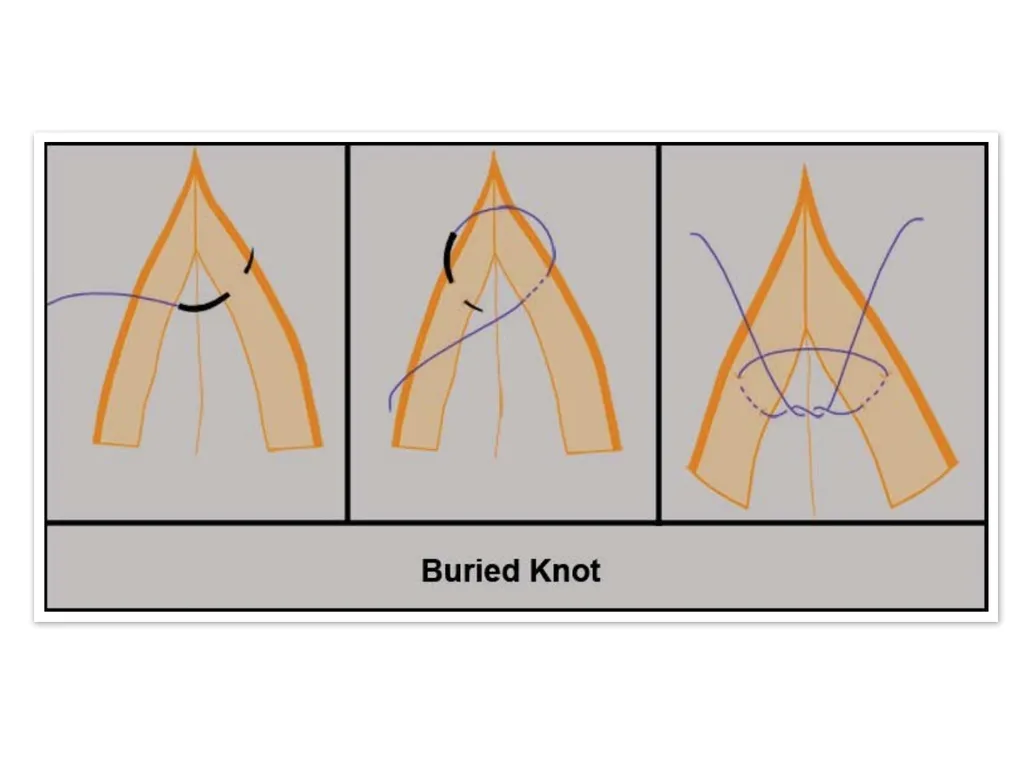Advanced Suturing for RVNs Zamantha Marshall - slide 21 of 27
