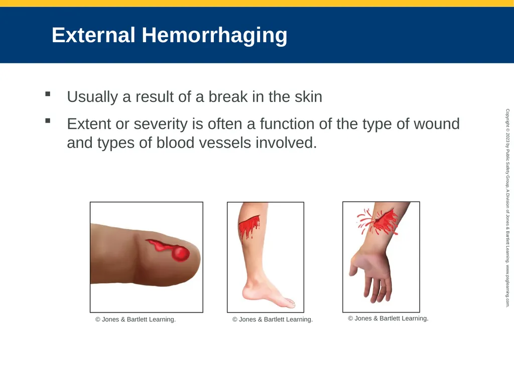 Bleeding CHAPTER 27: Focused Lecture National EMS - slide 11 of 34
