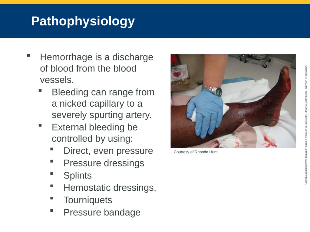 Bleeding CHAPTER 27: Focused Lecture National EMS - slide 10 of 34