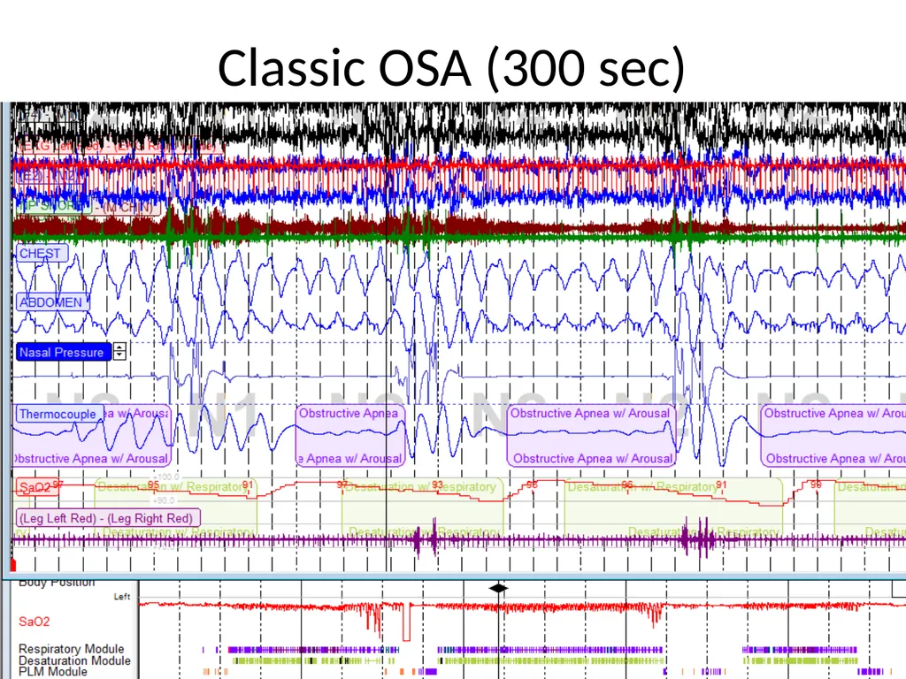 Interpreting Sleep Study Reports: A Primer for - slide 11 of 23
