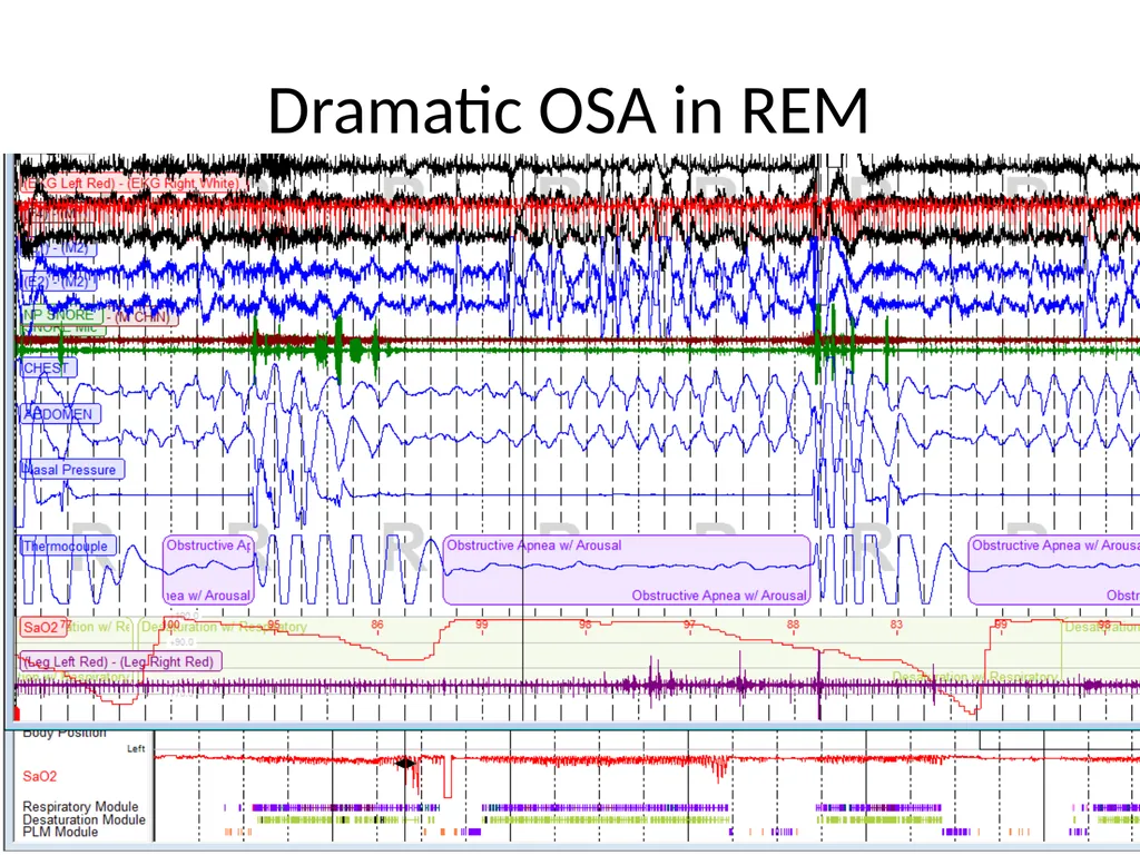 Interpreting Sleep Study Reports: A Primer for - slide 18 of 23