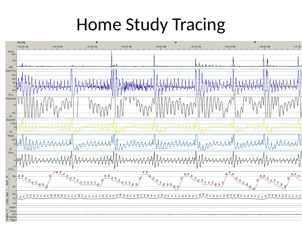 Interpreting Sleep Study Reports: A Primer for - slide 21 of 23