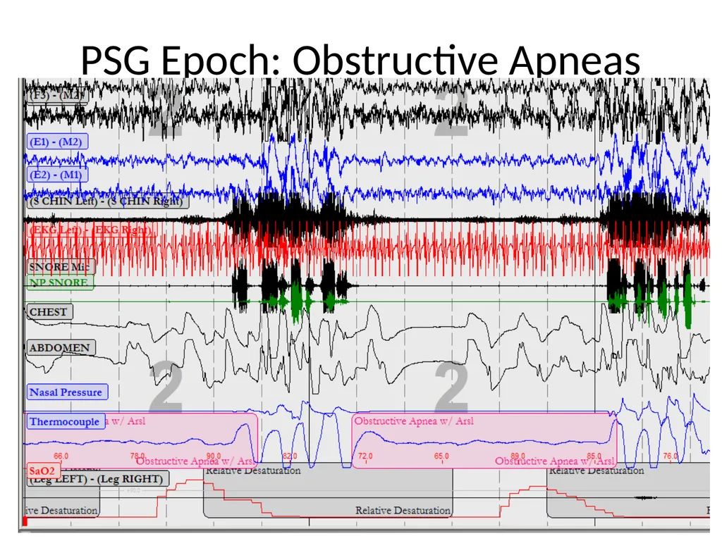 Interpreting Sleep Study Reports: A Primer for - slide 6 of 23