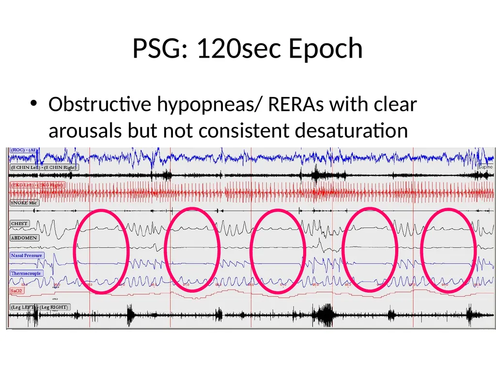Interpreting Sleep Study Reports: A Primer for - slide 19 of 23