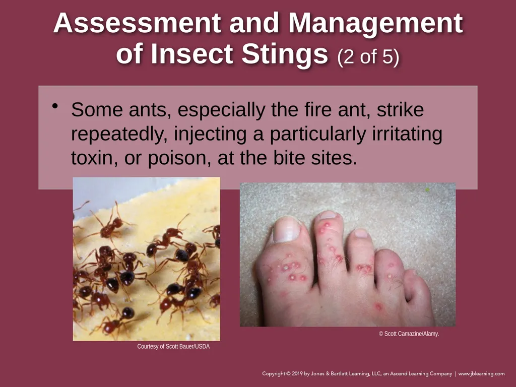 Focused Lecture Chapter 22 Immunologic Emergencies - slide 27 of 31