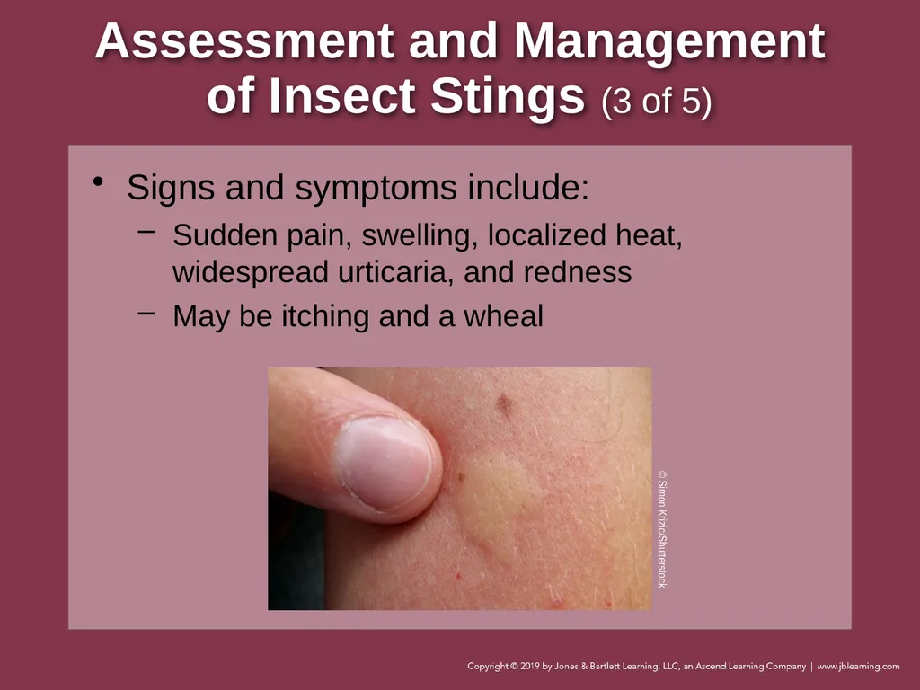 Focused Lecture Chapter 22 Immunologic Emergencies - slide 28 of 31