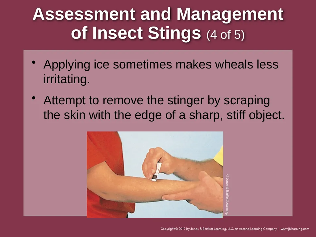 Focused Lecture Chapter 22 Immunologic Emergencies - slide 29 of 31