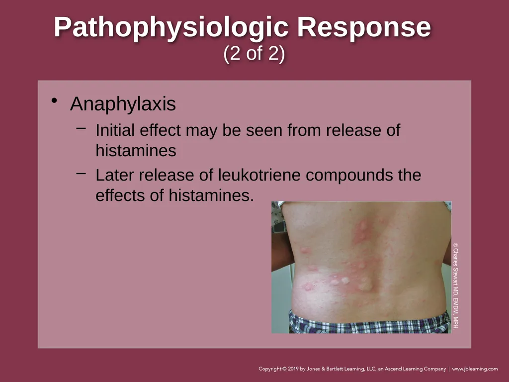 Focused Lecture Chapter 22 Immunologic Emergencies - slide 12 of 31