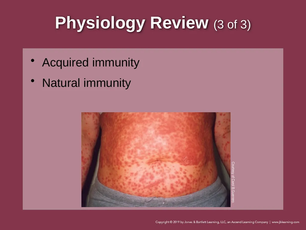 Focused Lecture Chapter 22 Immunologic Emergencies - slide 8 of 31