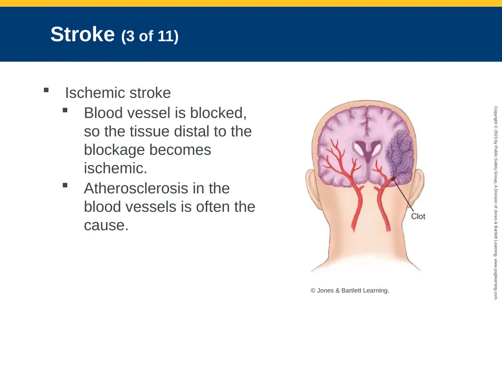 Neurologic Emergencies CHAPTER 19: Focused Lecture - slide 17 of 59