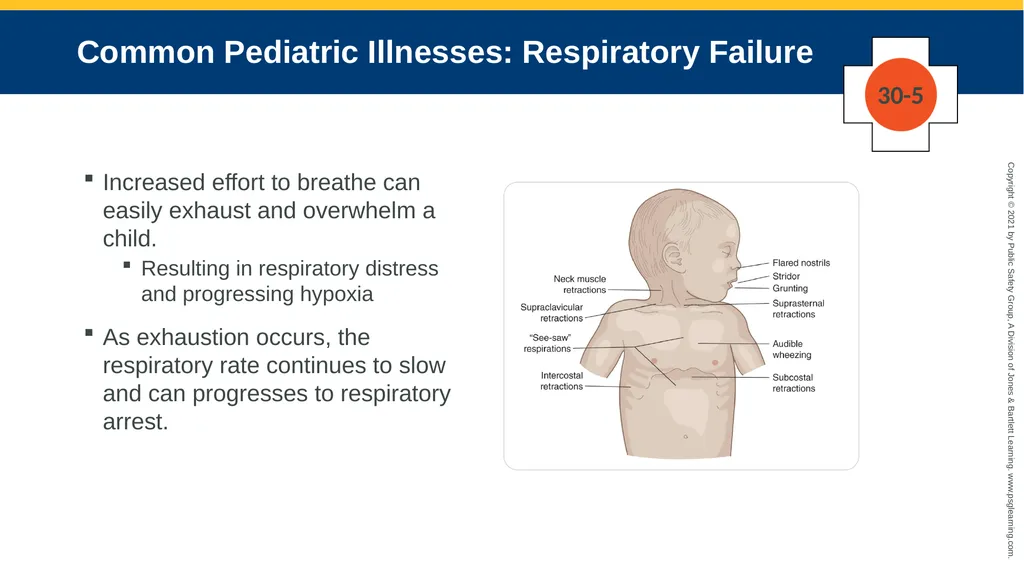 CHAPTER 30 Pediatric Emergencies The following - slide 39 of 105