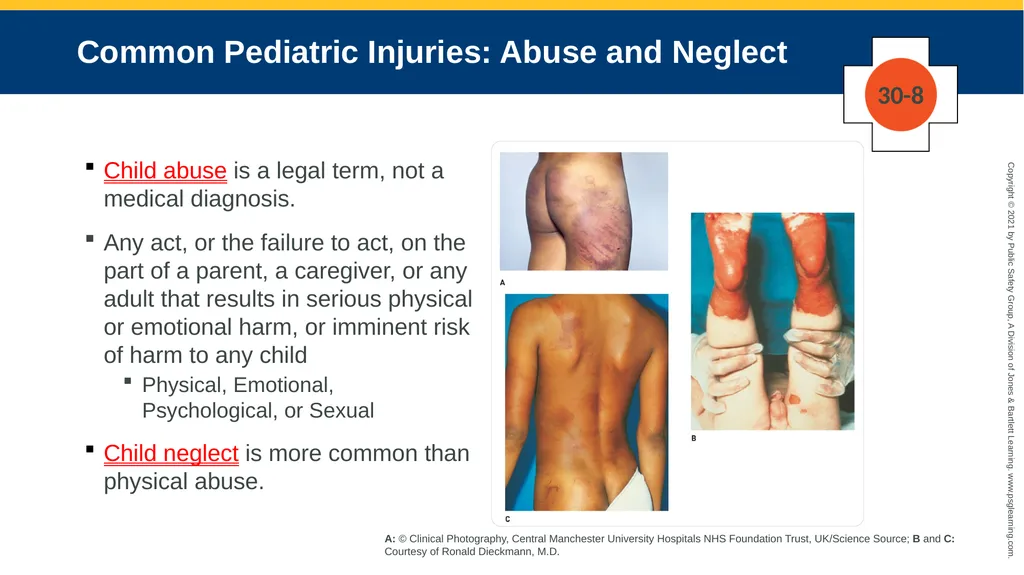 CHAPTER 30 Pediatric Emergencies The following - slide 47 of 105