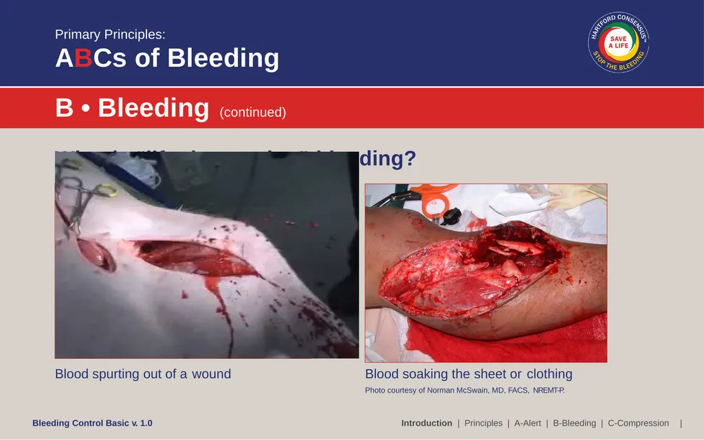 Bleeding Control (B-Con) Basic Copyright © 2017 by - slide 11 of 61