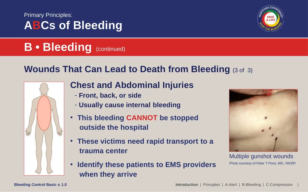 Bleeding Control (B-Con) Basic Copyright © 2017 by - slide 14 of 61