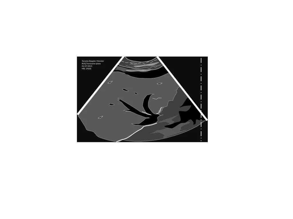 IVC Collapse Physiology knowing the caveats & - slide 5 of 33
