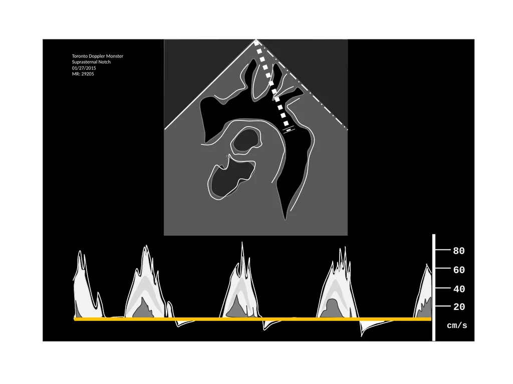 IVC Collapse Physiology knowing the caveats & - slide 17 of 33