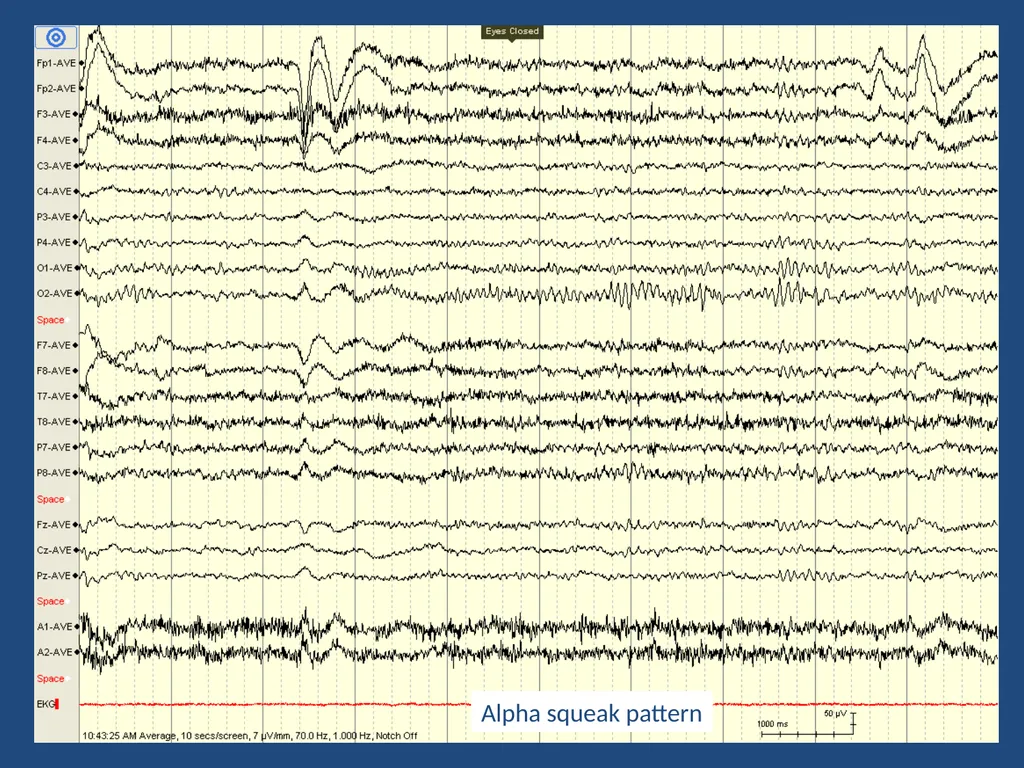 NORMAL ADULT EEG Amar B. Bhatt, MD, FAES Assistant - slide 9 of 66