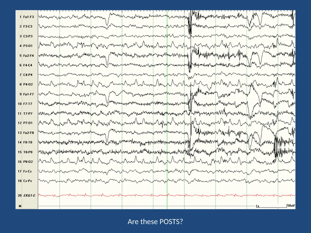 NORMAL ADULT EEG Amar B. Bhatt, MD, FAES Assistant - slide 64 of 66
