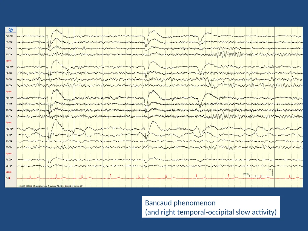 NORMAL ADULT EEG Amar B. Bhatt, MD, FAES Assistant - slide 11 of 66